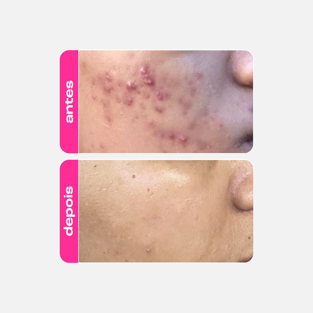 Refil Ácido Mandélico 30g