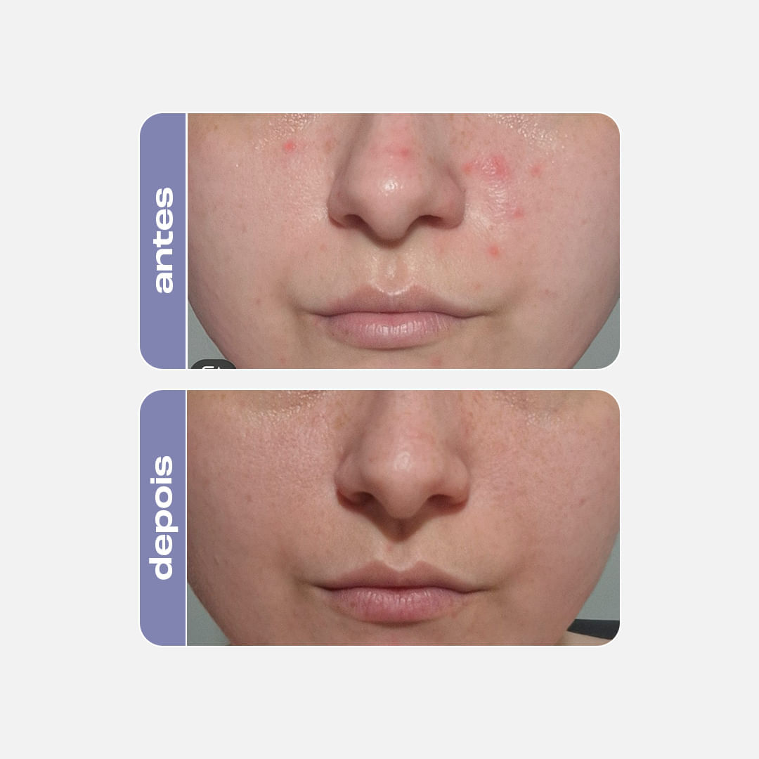 Sérum Antiacne Adapalenato